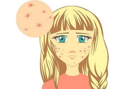 痤疮可以吃瓜吗,瓜类食物的适宜与禁忌